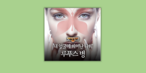 루프스