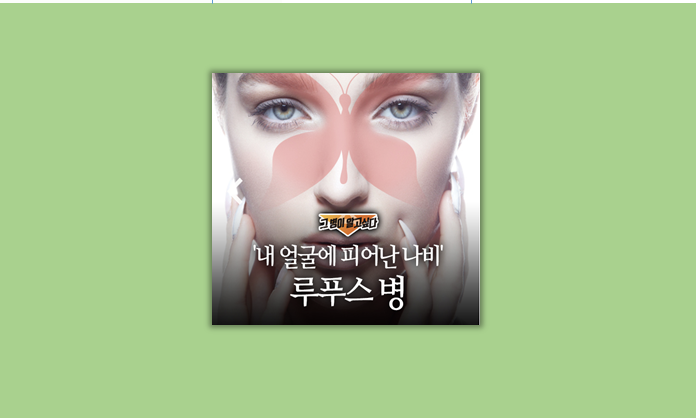 루프스